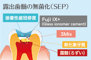 露出歯髄の無菌化（SEP）