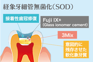 経象牙細管無菌化（SOD）