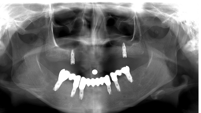 インプラント　症例