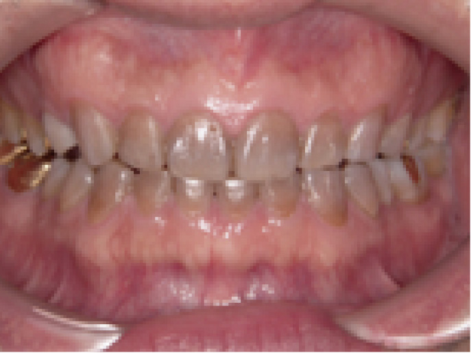 審美歯科修復・症例紹介（当院の症例）