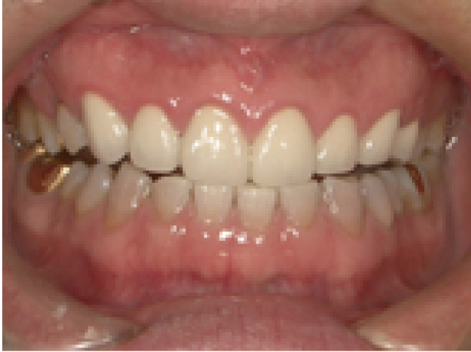 審美歯科修復・症例紹介（当院の症例）