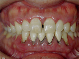 歯周病治療の経過 初診時