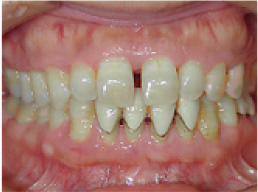 歯周病治療の経過 歯周病治療